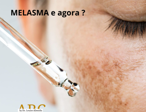 O que é Melasma?