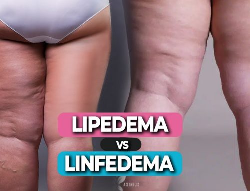 DIFERENCA ENTRE LIPEDEMA E CELULITE